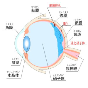 網膜裂孔