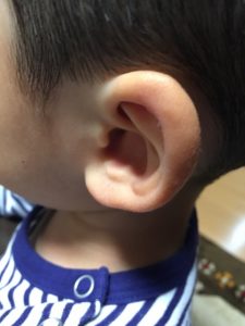 中耳炎をすると…